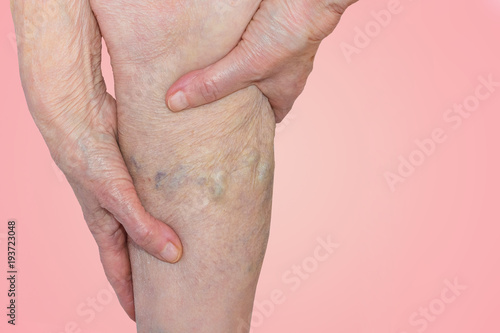 The varicose veins on a legs of old woman on blue