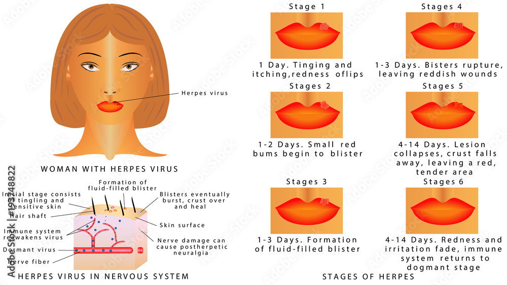 Fototapeta premium Herpes on lips