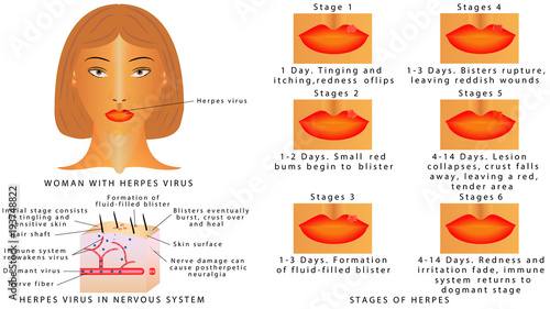 Herpes on lips