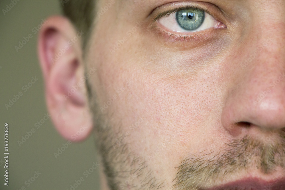 acne on the face. pores on the face acne on the face. pores on the face