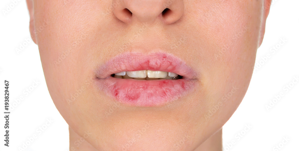 Dermatillomania skin picking. Woman has bad habit to pick her lips. Harmful addiction based on anxiety stress and dry lips. Excoriation disorder. Sick cracked damaged tissue.