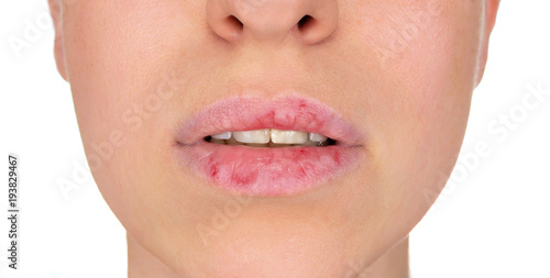 Obraz na płótnie Dermatillomania skin picking. Woman has bad habit to pick her lips. Harmful addiction based on anxiety stress and dry lips. Excoriation disorder. Sick cracked damaged tissue. w salonie