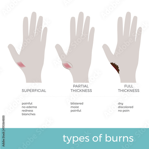 vector illustration of types of burns showed on hand