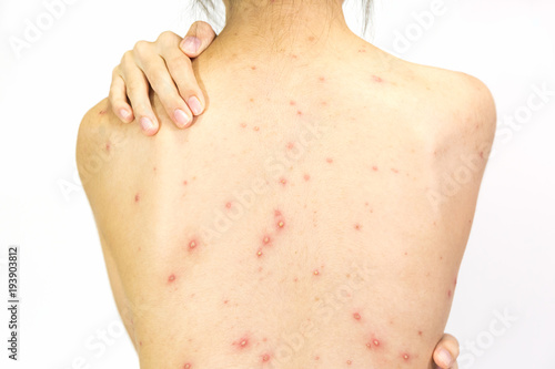 Closeup of girl back of Varicella virus or Chicken Pox on white background.