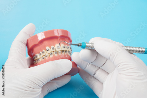 orthodontic model and dentist tool - demonstration teeth model of varities of orthodontic bracket or brace photo