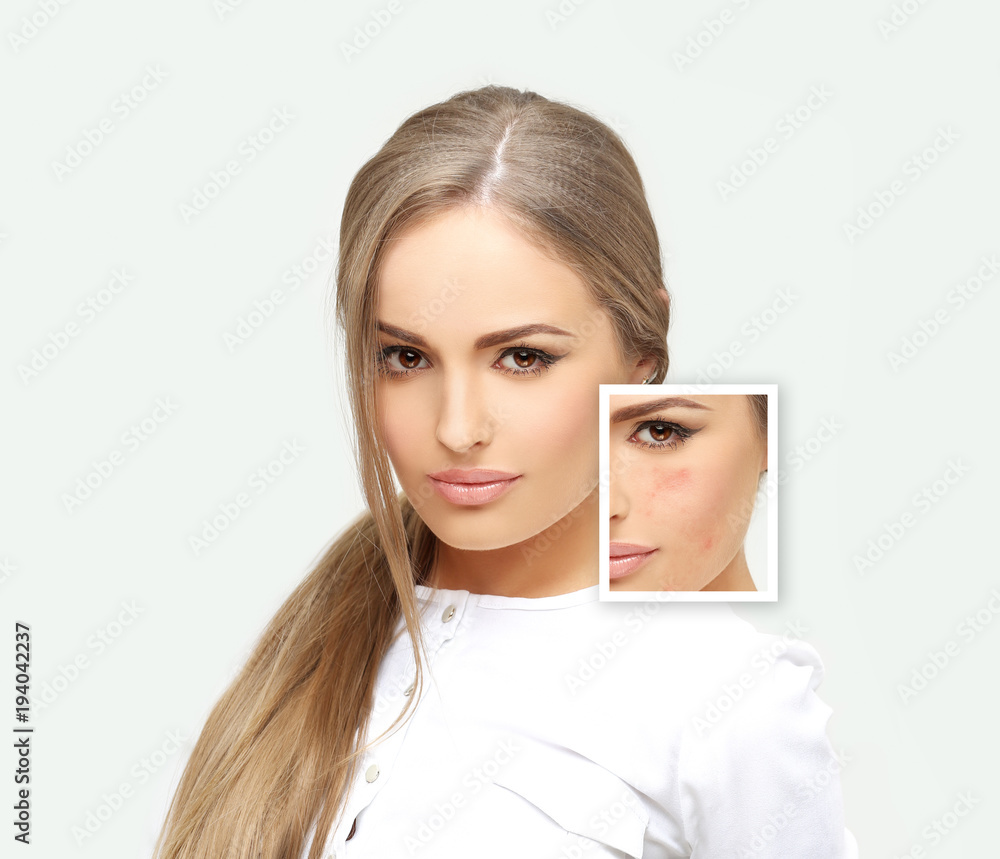 Post-Acne Marks /Treating Acne Scars Post-Acne Marks /Treating Acne Scars