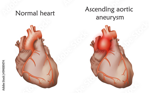 Ascending aortic aneurysm. Damaged and normal heart muscles. Anatomy illustration. Colorful image, white background.