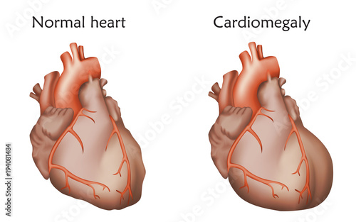 Cardiomegaly. Enlarged and normal heart muscles. Anatomy illustration. Colorful image, white background.