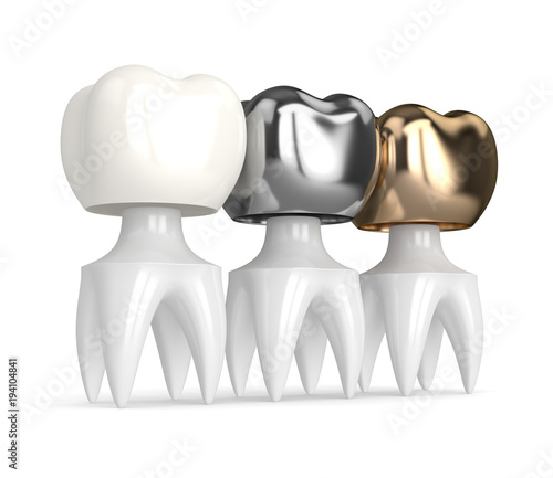 3d render of teeth with different types of dental crown