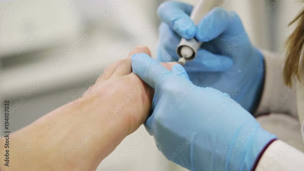 hands of the physician of the podologist in blue gloves make a hardware pedicure of male legs in the medical office, close-up hands of the physician of the podologist in blue gloves make a hardware pedicure of male legs in the medical office, close-up