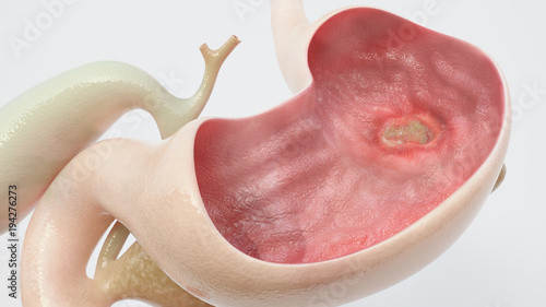 Stomach ulcer - high degree of detail - 3D Rendering photo