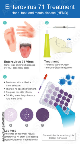 Potency Steroid Cream, Immune Globulin Injection, Gram stain testing. Illustration.