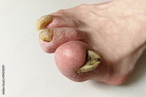 Fungus infection on nails of man's foot