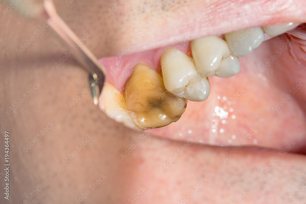 Obraz premium caries spoiled tooth closeup photographed