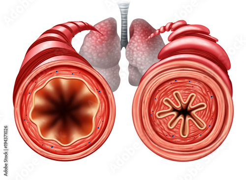 Asthma Diagram