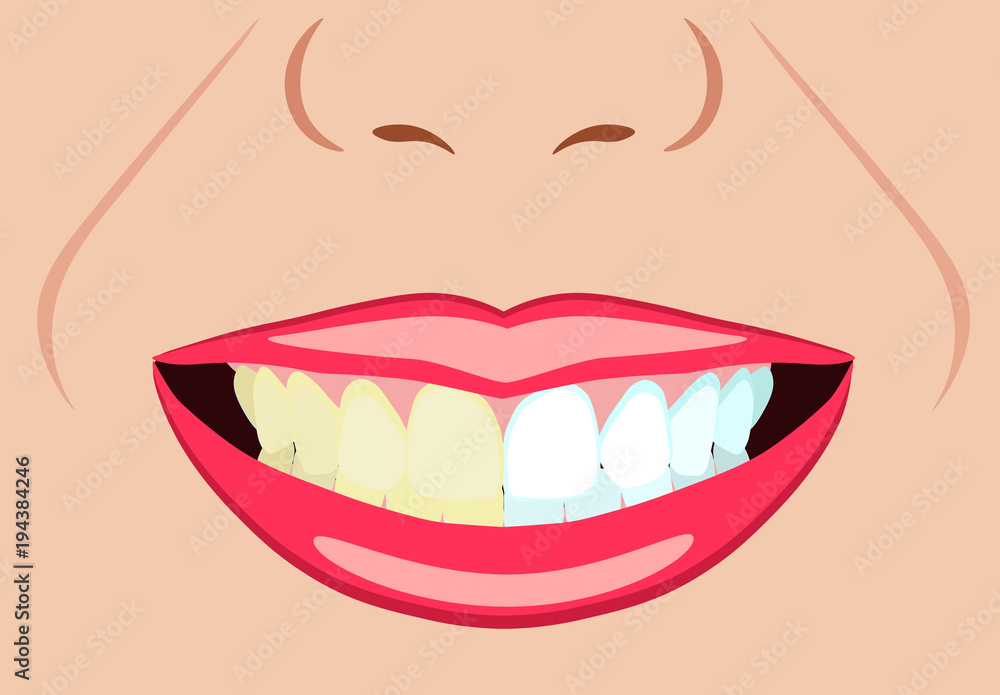 Vector face of girl and smile with bad and ideal teeth for dental and stomatological illustrations Vector face of girl and smile with bad and ideal teeth for dental and stomatological illustrations