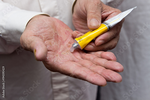 Ointment on the hands of an elderly person. Applying the ointment and emollient cream in the treatment and hydration of the skin . Problem skin in old age photo