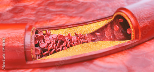 Konstfotografi Closeup of a atherosclerosis- 3D rendering