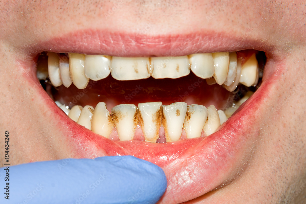 Fototapeta premium próchnica zepsuty zbliżenie zęba sfotografowany