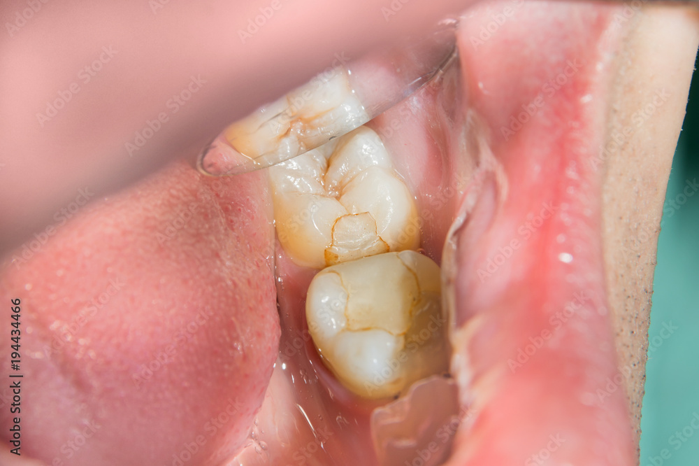 Obraz premium caries spoiled tooth closeup photographed