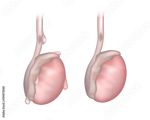 Side view of testicle showing twisted testicular appendage. An appendix testes (Hydatid of Morgagni). Testicular appendage torsion