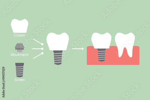 structure of the dental implant with all parts disassembled, crown, abutment, screw - compare with strong tooth