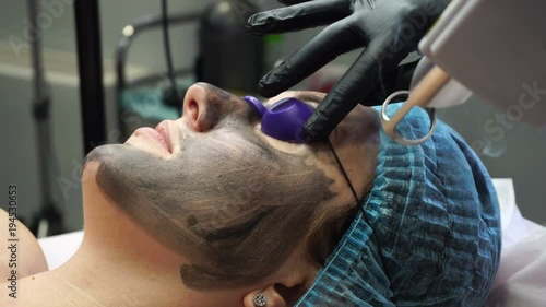Beautician laser removes old skin with carbon fiber layer. Carbon peeling. Laser flash.