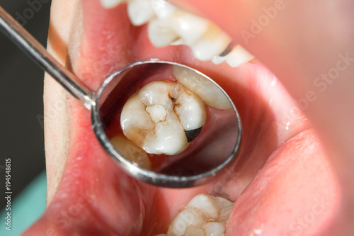 close-up of a human rotten carious tooth at the treatment stage in a dental clinic