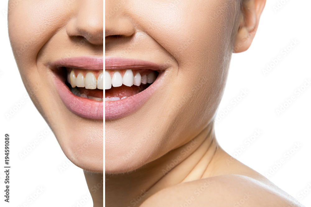 Teeth before and after care, therapy and whitening. Laughing woman mouth with great teeth over white background. Healthy beautiful female smile.