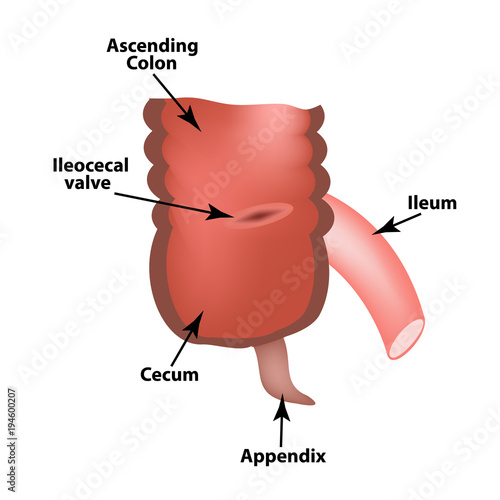 Ileocecal angle. Ileocecal valve. Bauginiev s damper. The ileum, the Cecum, the Apendix. Colon. Infographics. Vector illustration on isolated background.