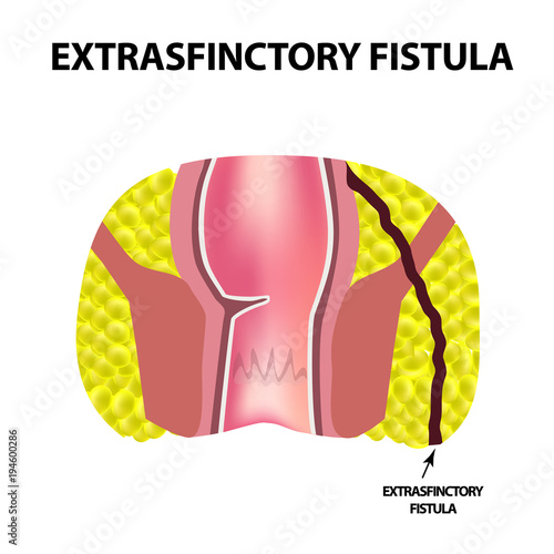 Types of fistulas of the rectum. Paraproctitis. Anus. Abscess of the rectum. Infographics. Vector illustration on isolated background