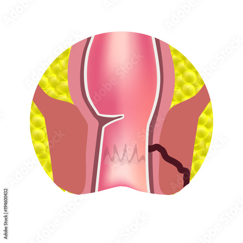 Types of fistulas of the rectum. Paraproctitis. Anus. Abscess of the rectum. Infographics. Vector illustration on isolated background