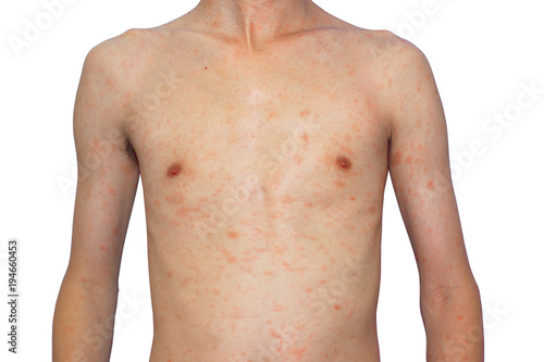 rash on skinny body, man suffering from virus, allergies skin, front view of a man with skin rash on white background, isolate with clipping path