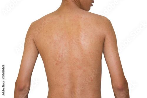 rash on dermatitis problem , allergy rash, rash on back, skin problem,Pityriasis Rosea,isolate on white background , clipping path