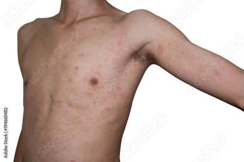 man show his rash body, allergies symptom, skinny man suffering from virus infected on white background with clipping path photo