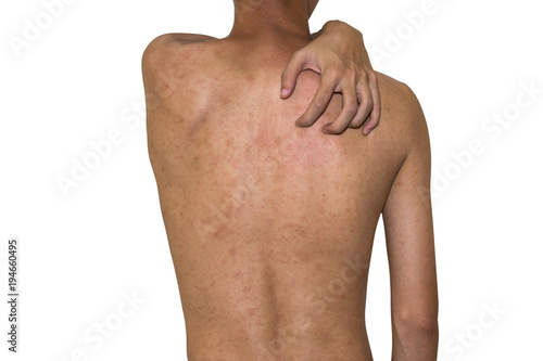 man scratching his itchy back with allergy rash, skin diseases, health problem,isolate on white background, clipping path,Petyriasis rosea