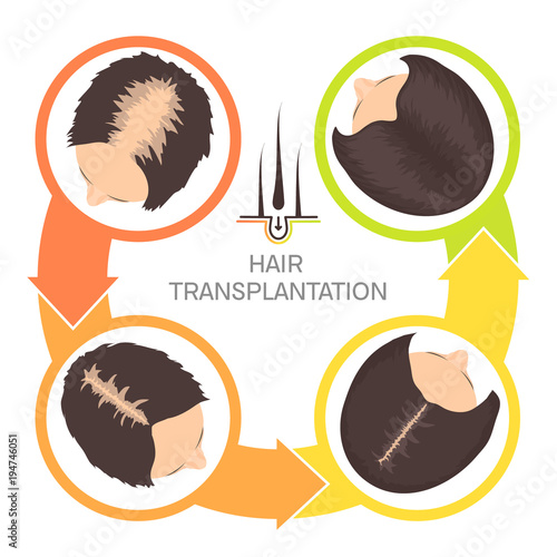 Hair transplantation surgery 4 steps infographics. Woman patient before and after the procedure. Female hair loss treatment with FUT, FUE method. Alopecia medical design for clinics.