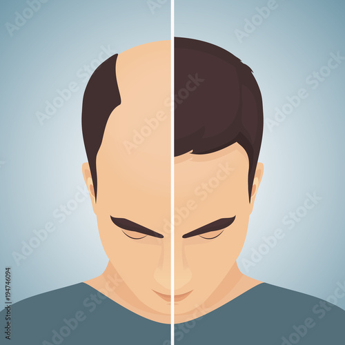 Front view portrait of a man with alopecia before and after hair treatment and transplantation. Divided image of the head. Two halves. Health care and beauty concept. Vector illustration.