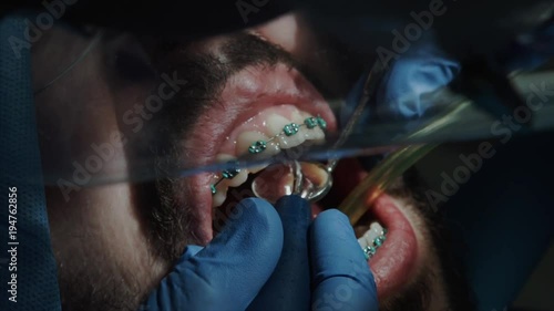 Dentists with a patient during a dental intervention to boy. Dentist Concept photo