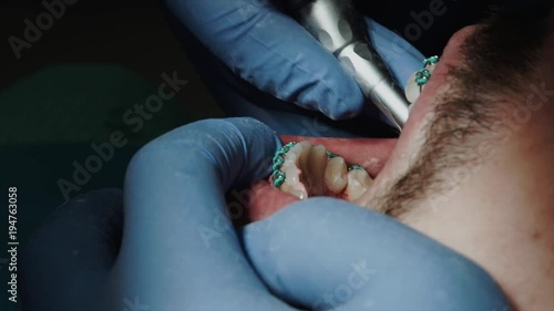 Dentists with a patient during a dental intervention to boy. Dentist Concept photo