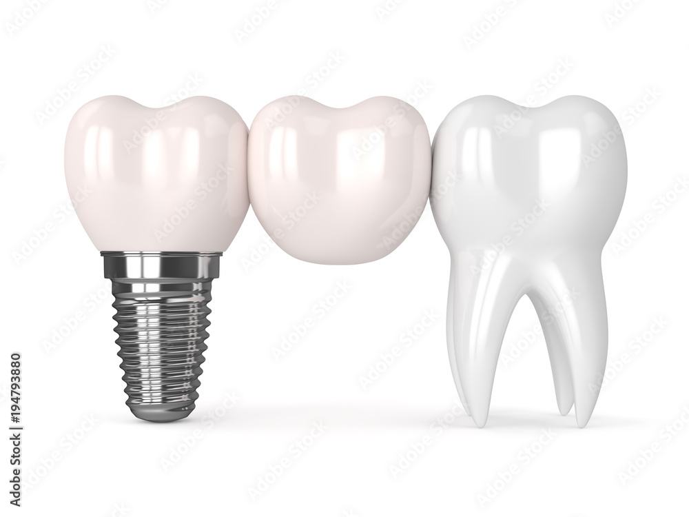 3d render of implant with dental cantilever bridge 3d render of implant with dental cantilever bridge