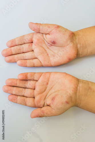 Canvastavla chicken pox hand.