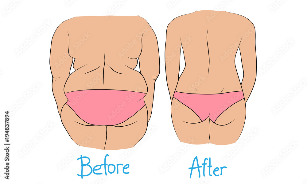Woman back fat before and after weight loss