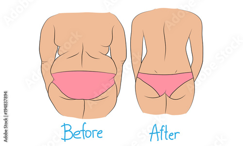 Woman back fat before and after weight loss
