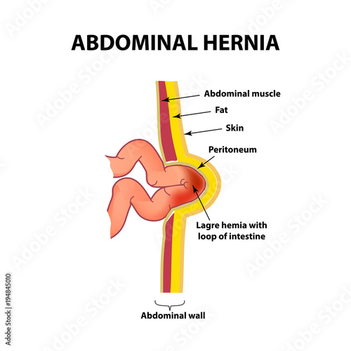 Intestinal hernia. Infographics. Vector illustration on isolated background.