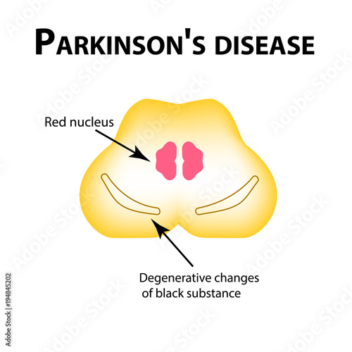 Parkinson's disease. Degenerative changes in the brain are a black substance. Vector illustration on isolated background.