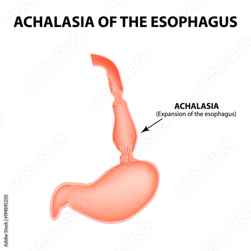Achalasia of the esophagus. Expansion of the esophagus. Hernia. Infographics. Vector illustration on isolated background photo