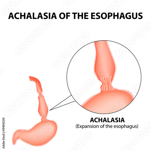 Achalasia of the esophagus. Expansion of the esophagus. Hernia. Infographics. Vector illustration on isolated background