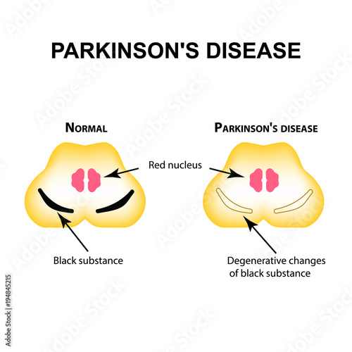 Parkinson's disease. Degenerative changes in the brain are a black substance. Vector illustration on isolated background.