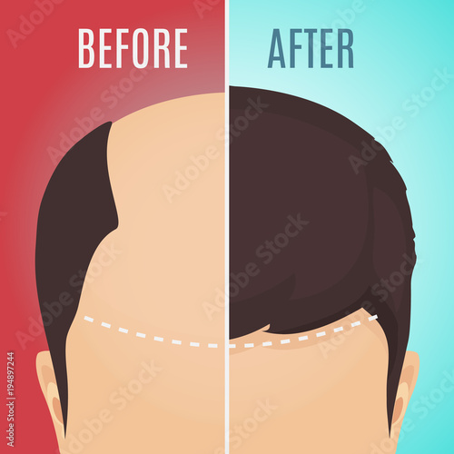 Top view portrait of a man before and after hair treatment and transplantation. Divided image of the head on red and blue background. Two halves. Vector illustration.